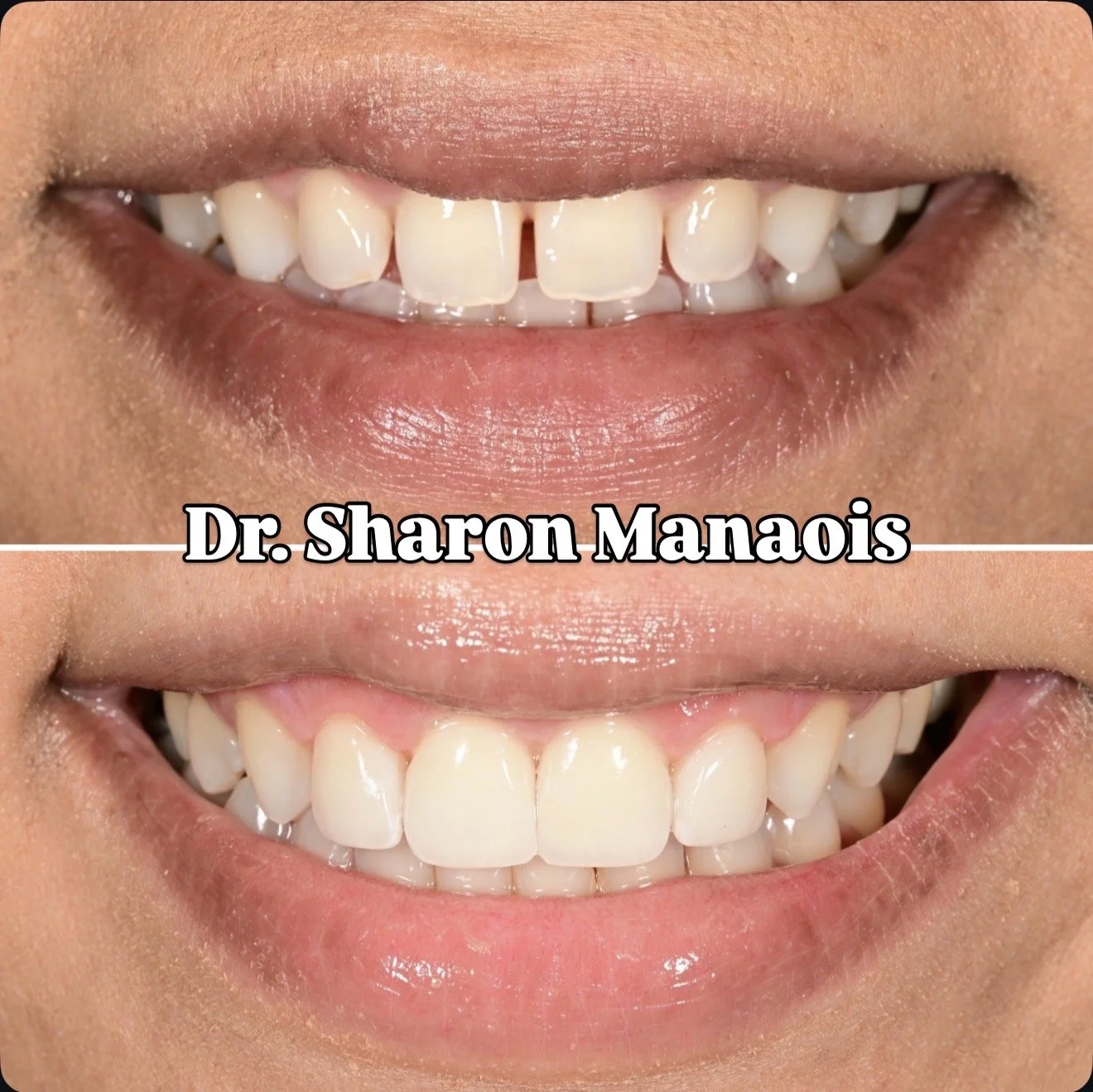No-Prep Veneers