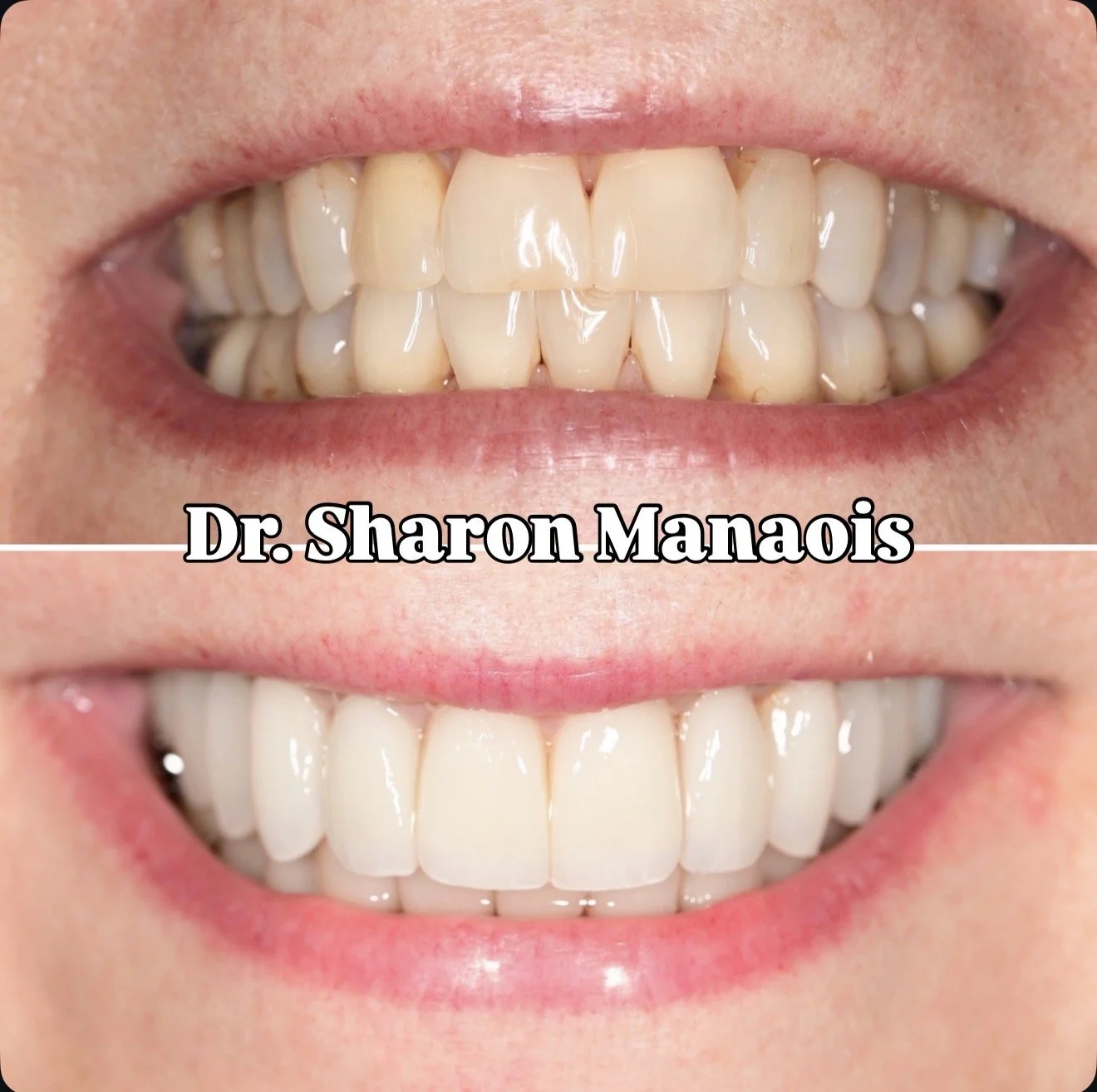 Veneers