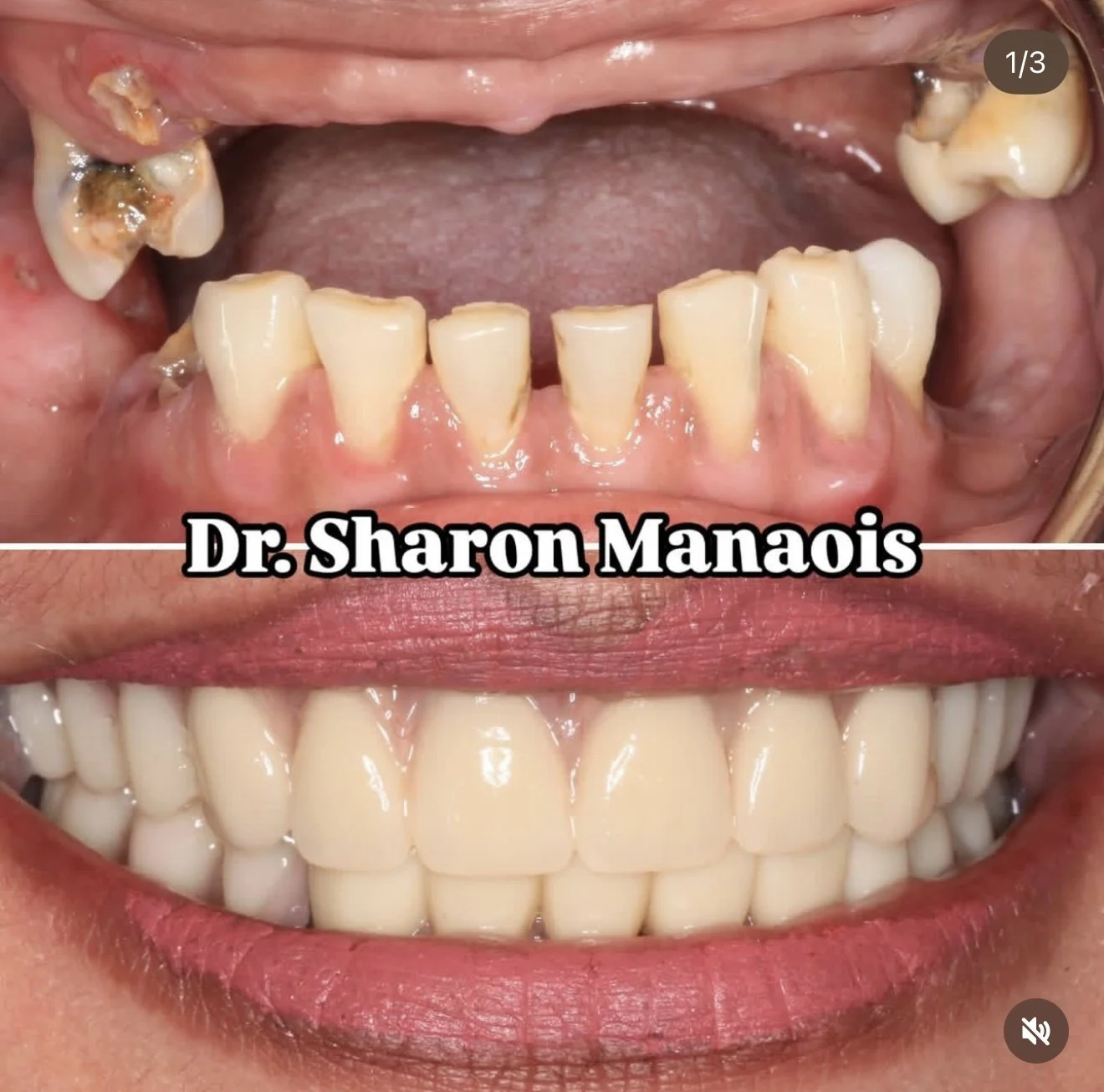 Dentures, Crowns