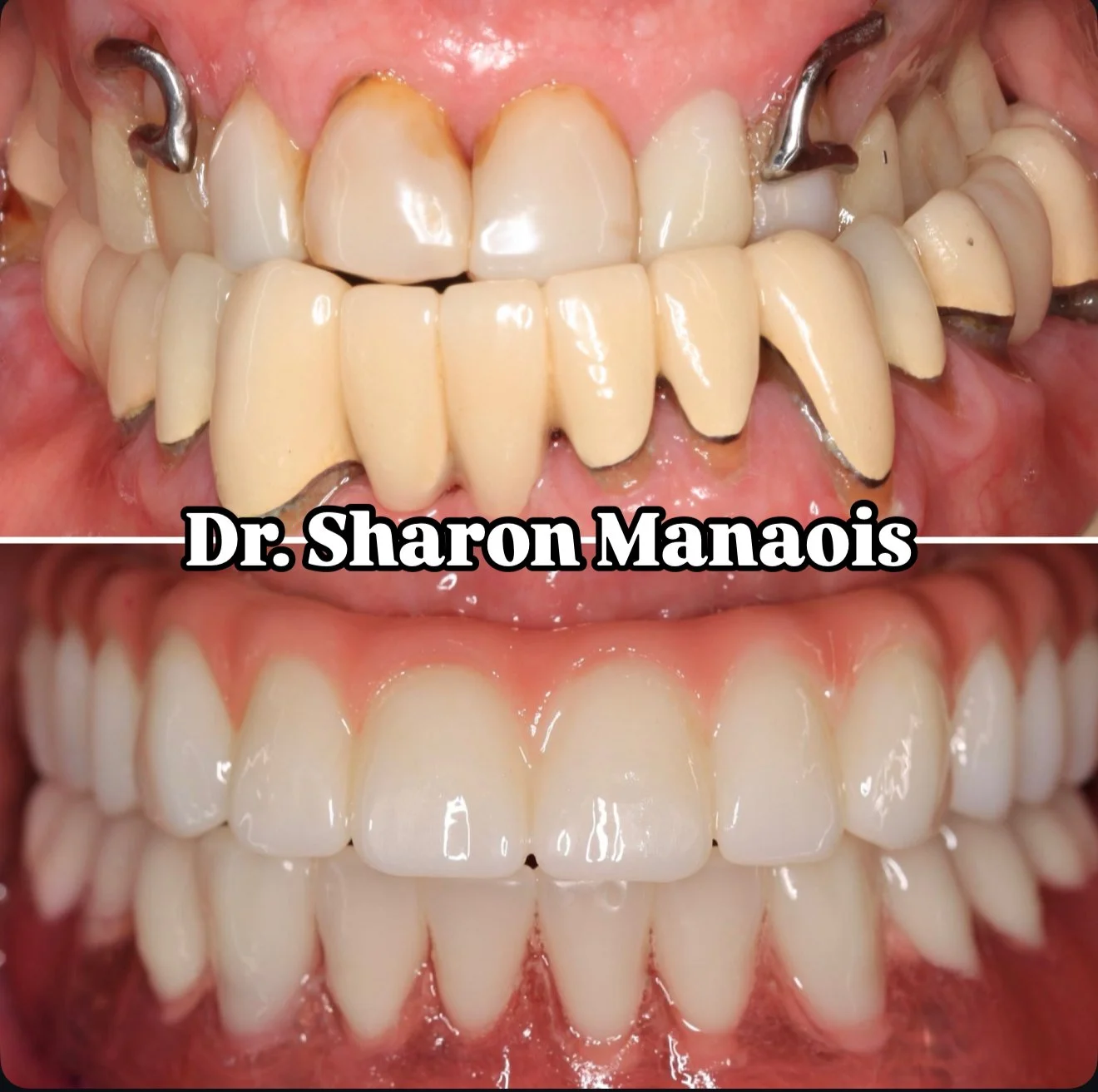 All on X, Snap-in Denture