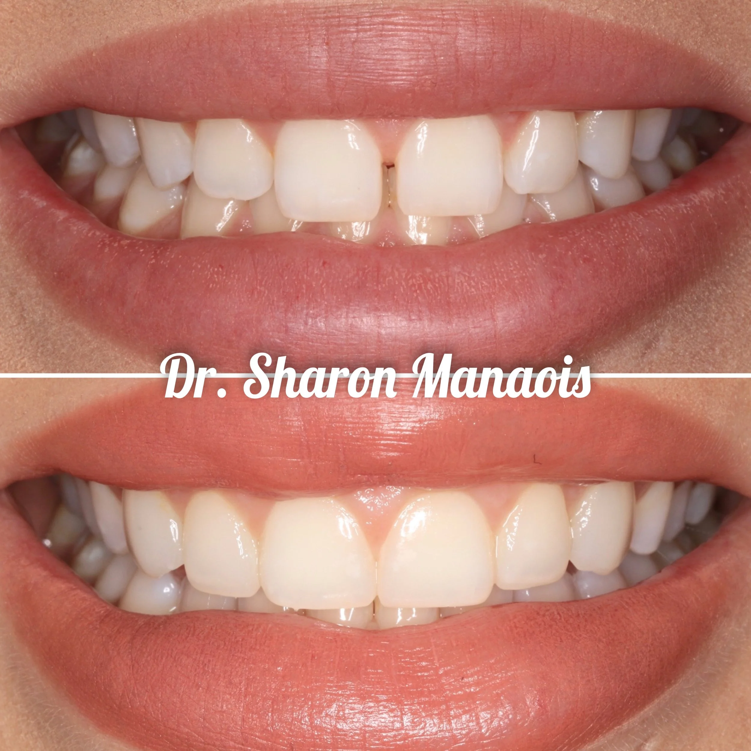 Composite Veneers