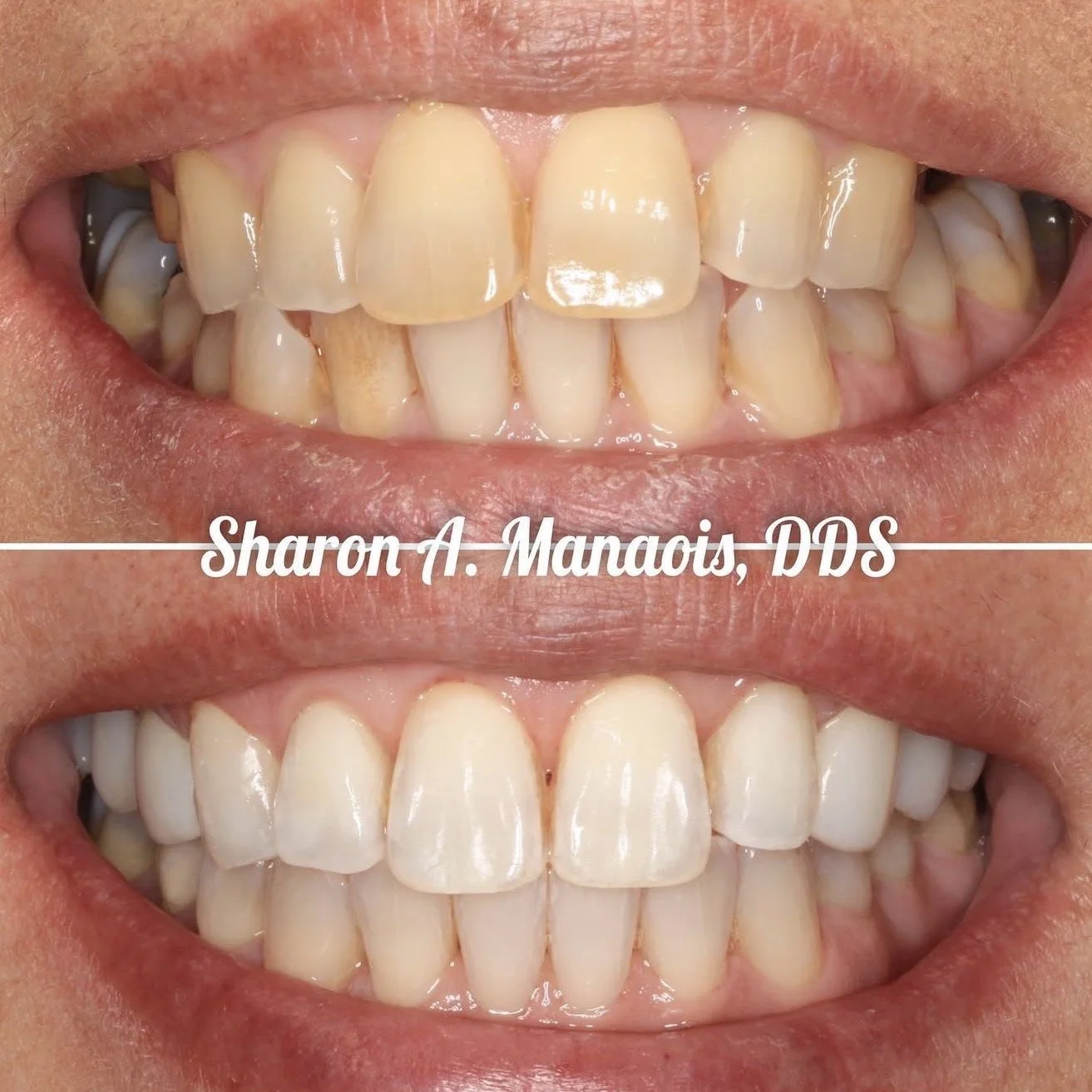 Invisalign, KOR Whitening