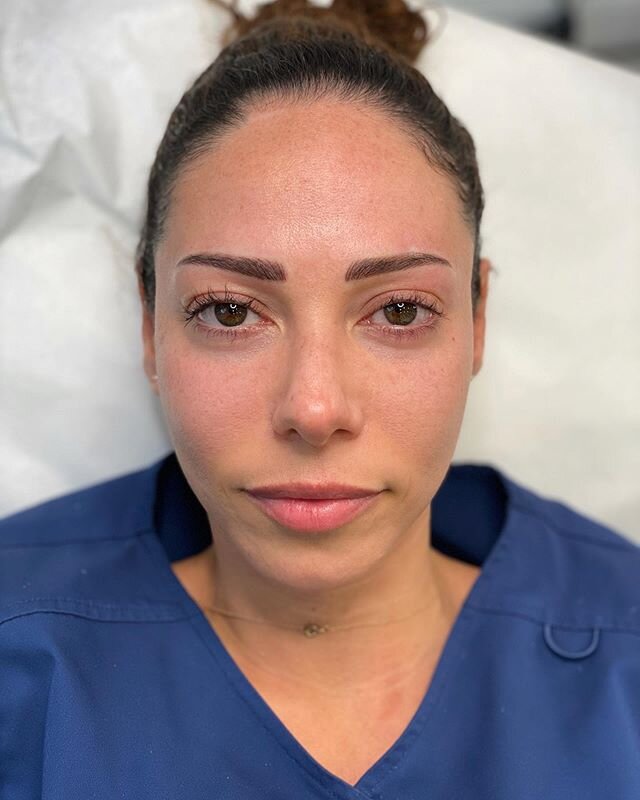 ✨1 year touch up &amp; a lash lift by Renee ⏩ Swipe to see before +
#microblading #beforeandafter #browtransformation #eyebrows #brows #beauty #tattoo #lashlift #semipermanentmakeup #pmu #eyebrowtattoo #browshaping #browsonpoint #newyork #nyc