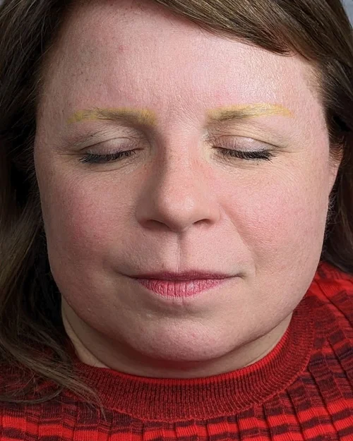 Substantial pigment clearing after third removal session &mdash; Le Kitsun&eacute; NYC laser removal