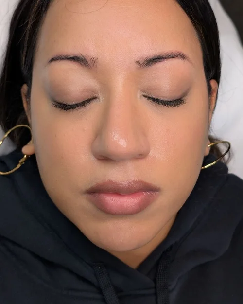 Further pigment lightening after second removal session &mdash; Le Kitsun&eacute; NYC correction