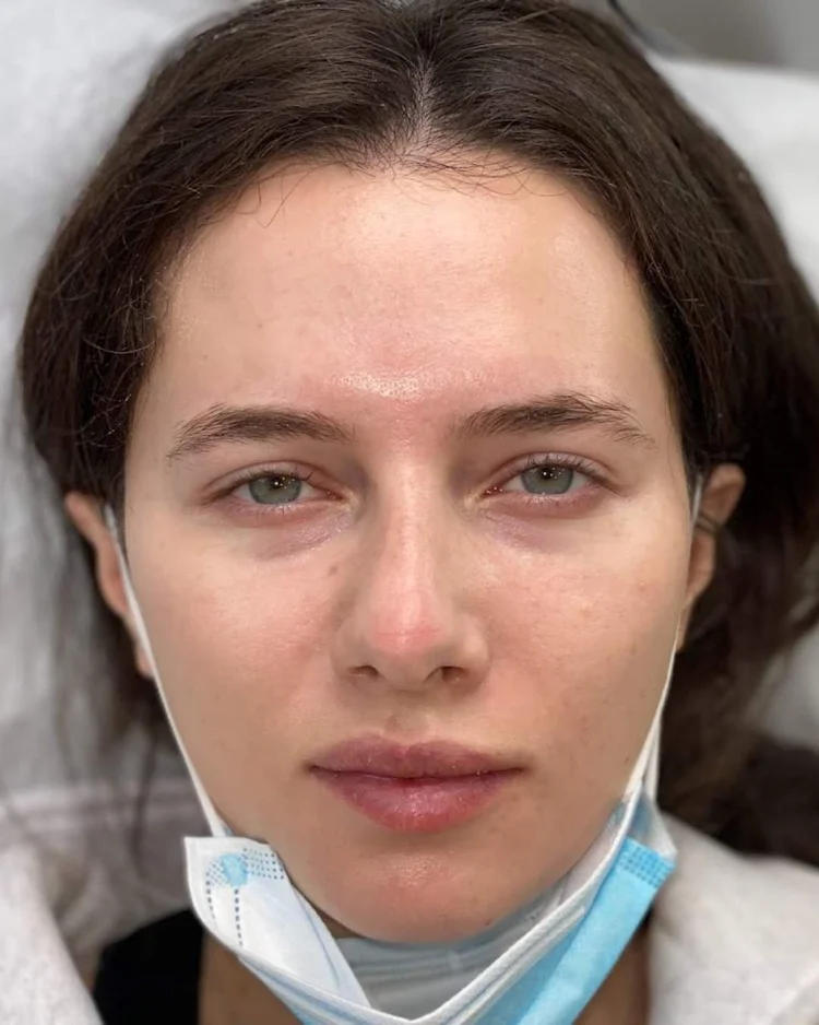 Before hybrid brow treatment — sparse mis-shaped eyebrows on light skin tone — Le Kitsuné NYC