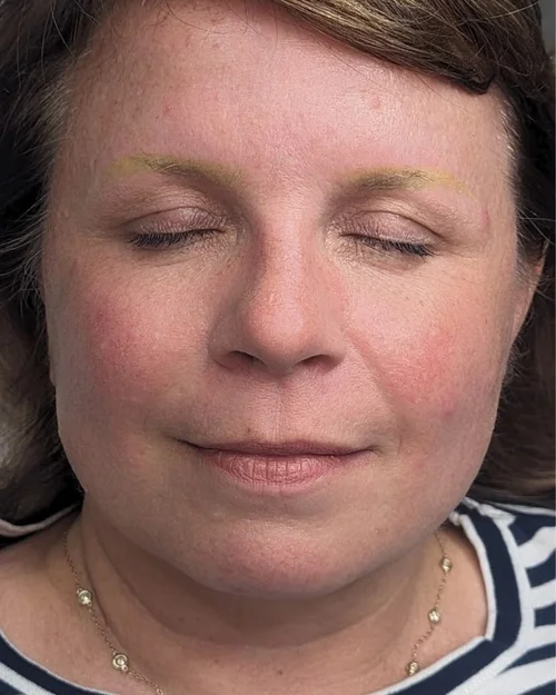 Brow canvas nearly clear after extended removal sessions &mdash; Le Kitsun&eacute; NYC permanent makeup removal