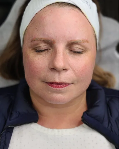 Progressive pigment fading and true undertone emerging &mdash; Le Kitsun&eacute; Manhattan brow removal