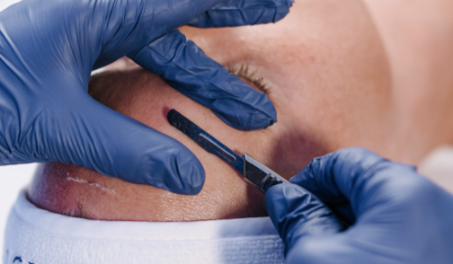 woman lying down receiving dermaplane procedure