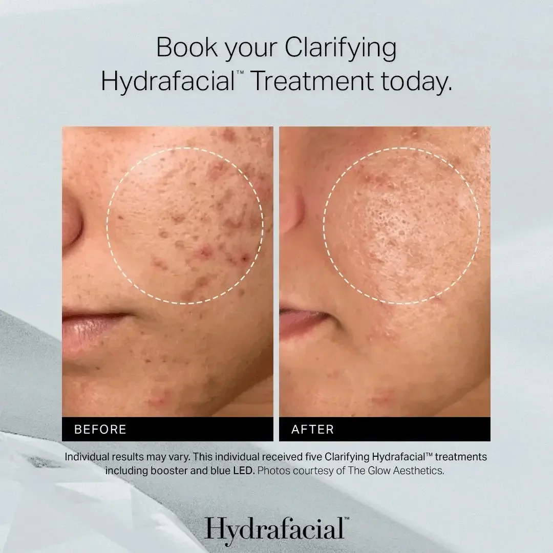 Recieve the best skin of your life. CLARIFYING HYDRAFACIAL BEFORE AND AFTER PICTURE AT DKPESTHETICS