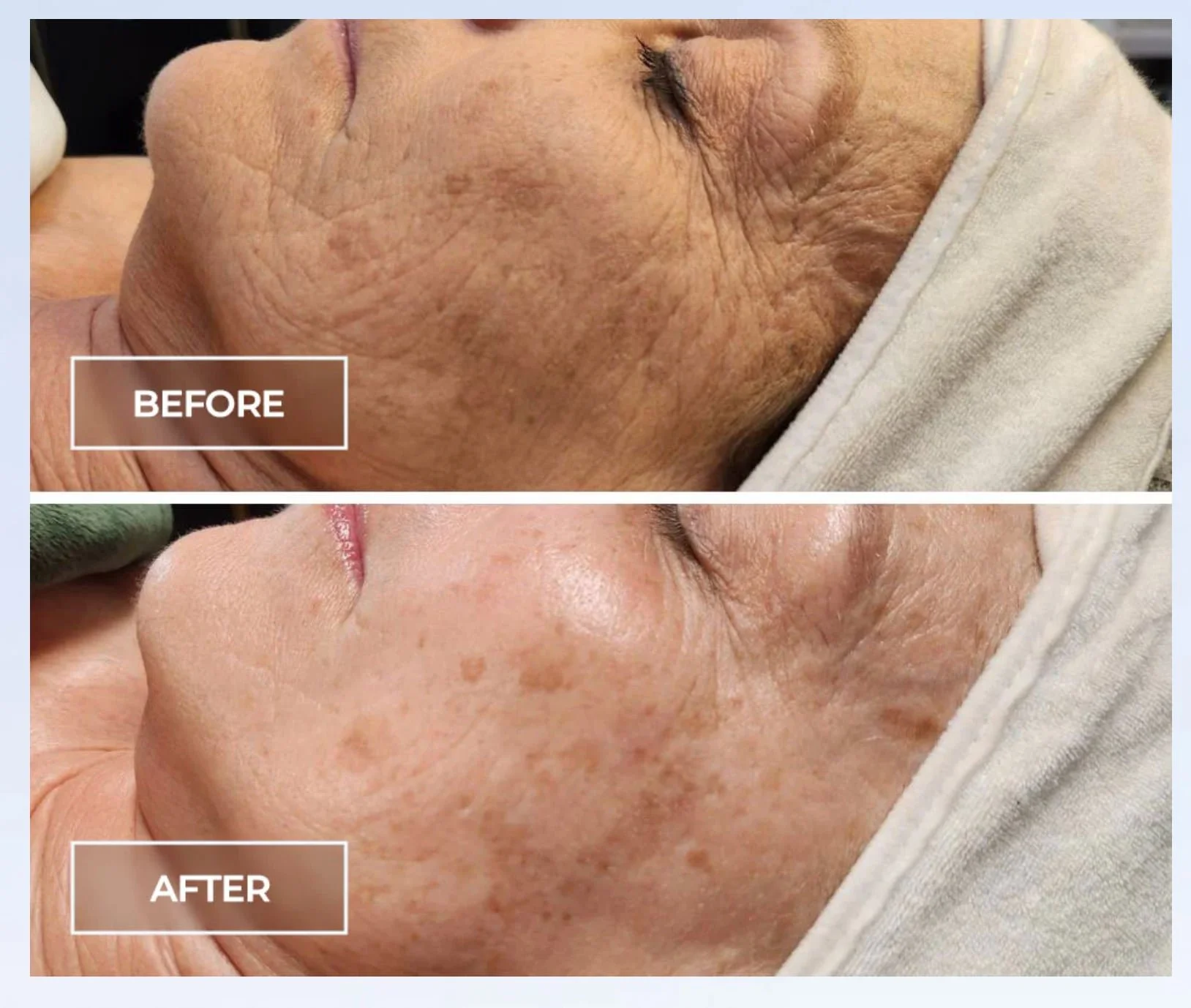 Left side of face of a before and after client of SWiCH procedure