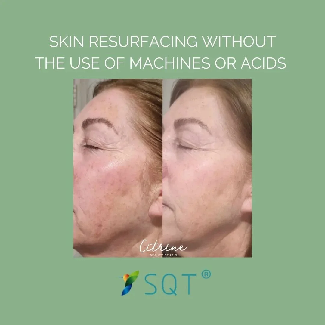 ...and that's just one of the many reasons I LOVE Sqt Bio-Mirconeedling!
Check out my beautiful clients results, reducing the appearance of pigmentation using SQT.
SQT® Bio-Microneedling is a professional treatment that is painless with no brea