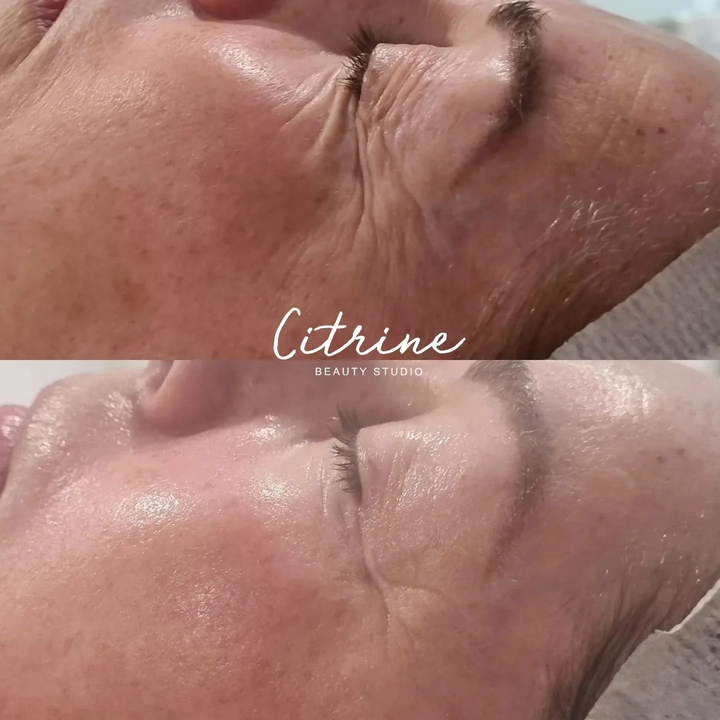 SQT RESULTS 🤩✨️
*I'm so proud of these results!.🥹😍
A few months ago, I brought in a new facial treatment, and WOW, it has been delivering! 🙌 
It's called SQT Bio Mirconeedling. A natural alternative to traditional Mirconeedling that requires n