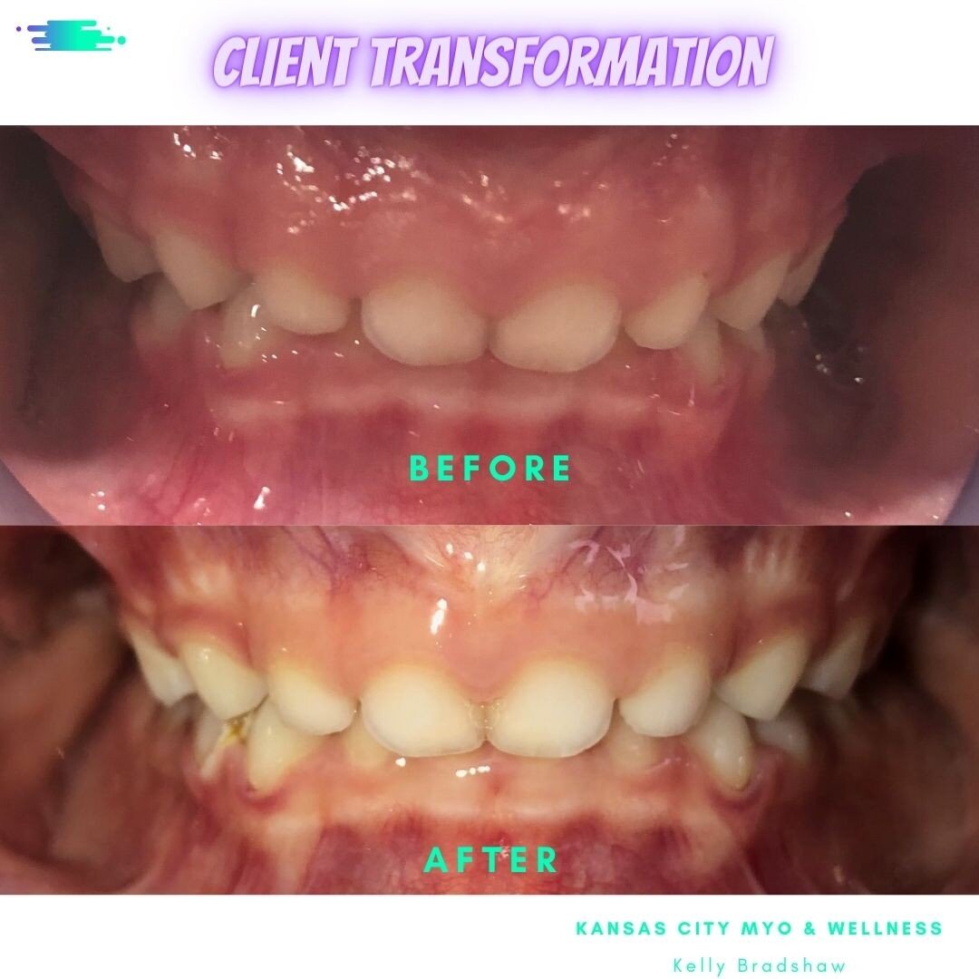 Check out the change in this 5 year old's bite. 
Here's what I see:

Her upper and lower jaw have widened which is super important to make room for her permanent teeth that will be erupting in the future.  Her bite is no longer as deep (notice how he