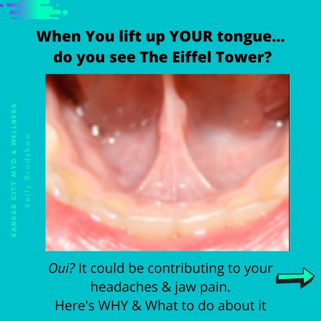 Comment below if you see the Eiffel Tower when you open and lift up YOUR tongue.
I'm curious how many of you will see it. 

#tonguetiesigns #tonguetie #ankyloglossia #necktension #tensionheadache #jawpain #tightshoulders #posture #tongueexercise #cle