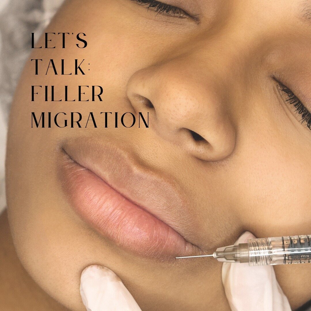 Do you think your filler has moved around? 😥 

It is a possibility, and we are here to break it down for you! 

Filler Migration is defined as the process of dermal filler spreading or &ldquo;migrating&rdquo; to another area beyond the site of injec