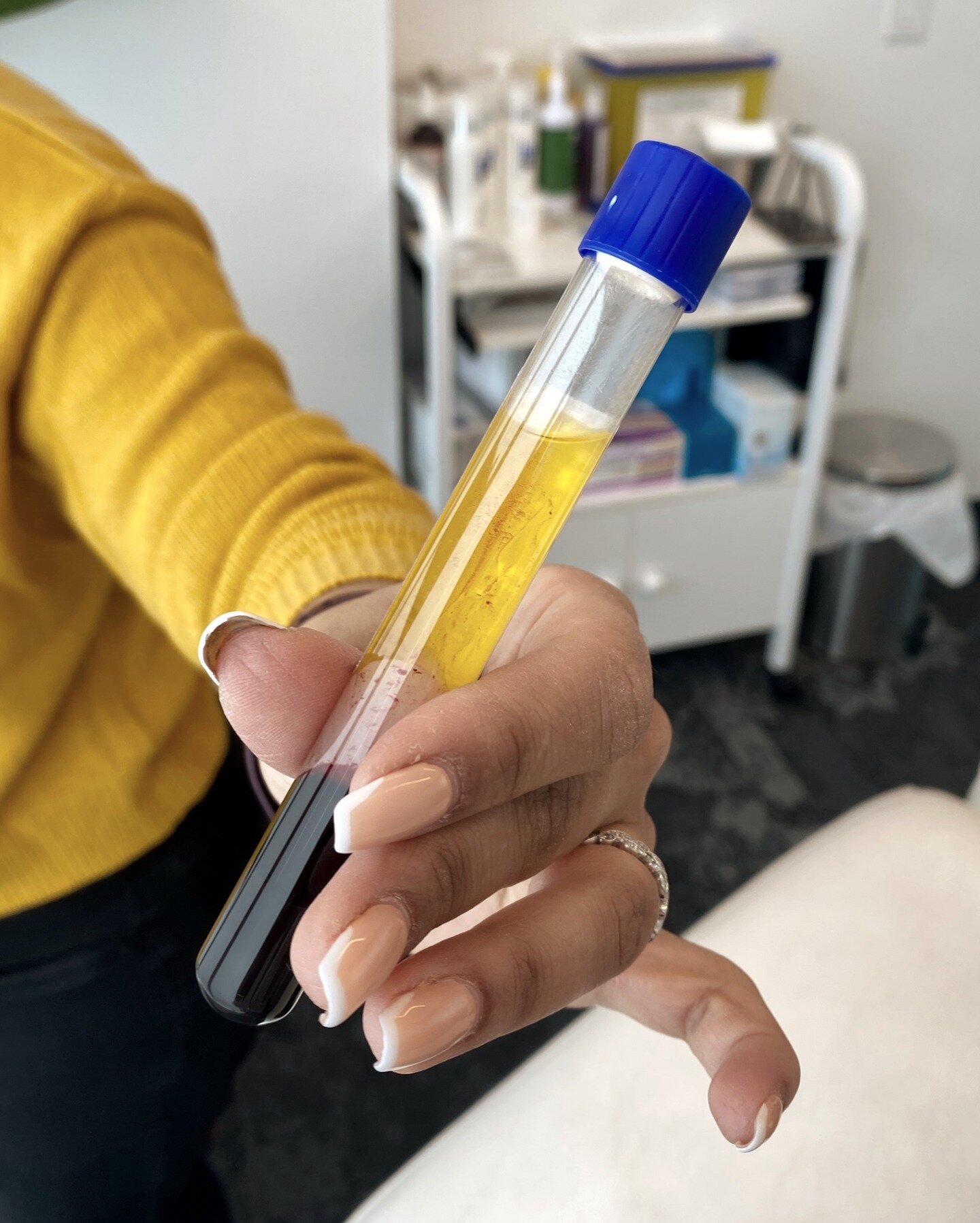 ✨ PRP in a nutshell ✨

Platelet-rich plasma (PRP) consists of two elements: 

👉 Plasma, or the liquid portion of blood, and platelets, a type of blood cell that plays an important role in healing throughout the body. 

👉 Platelets are well-known fo