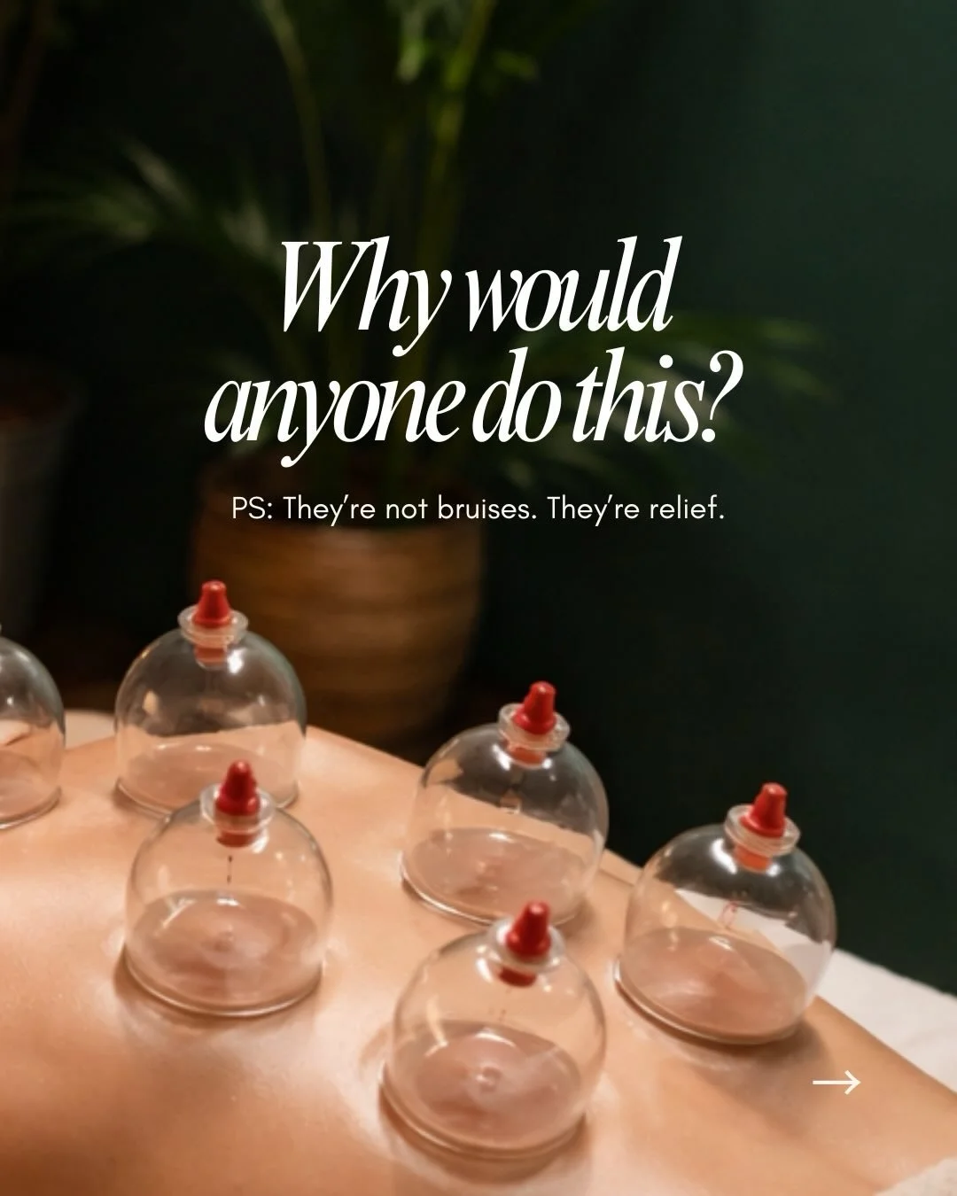 At first glance &hellip; it looks intense. Those circular marks, the colour, the idea of suction on your skin - we get why people hesitate or think, &ldquo;why would anyone do this?&rdquo;

But here&rsquo;s what most people don&rsquo;t realize: Cuppi