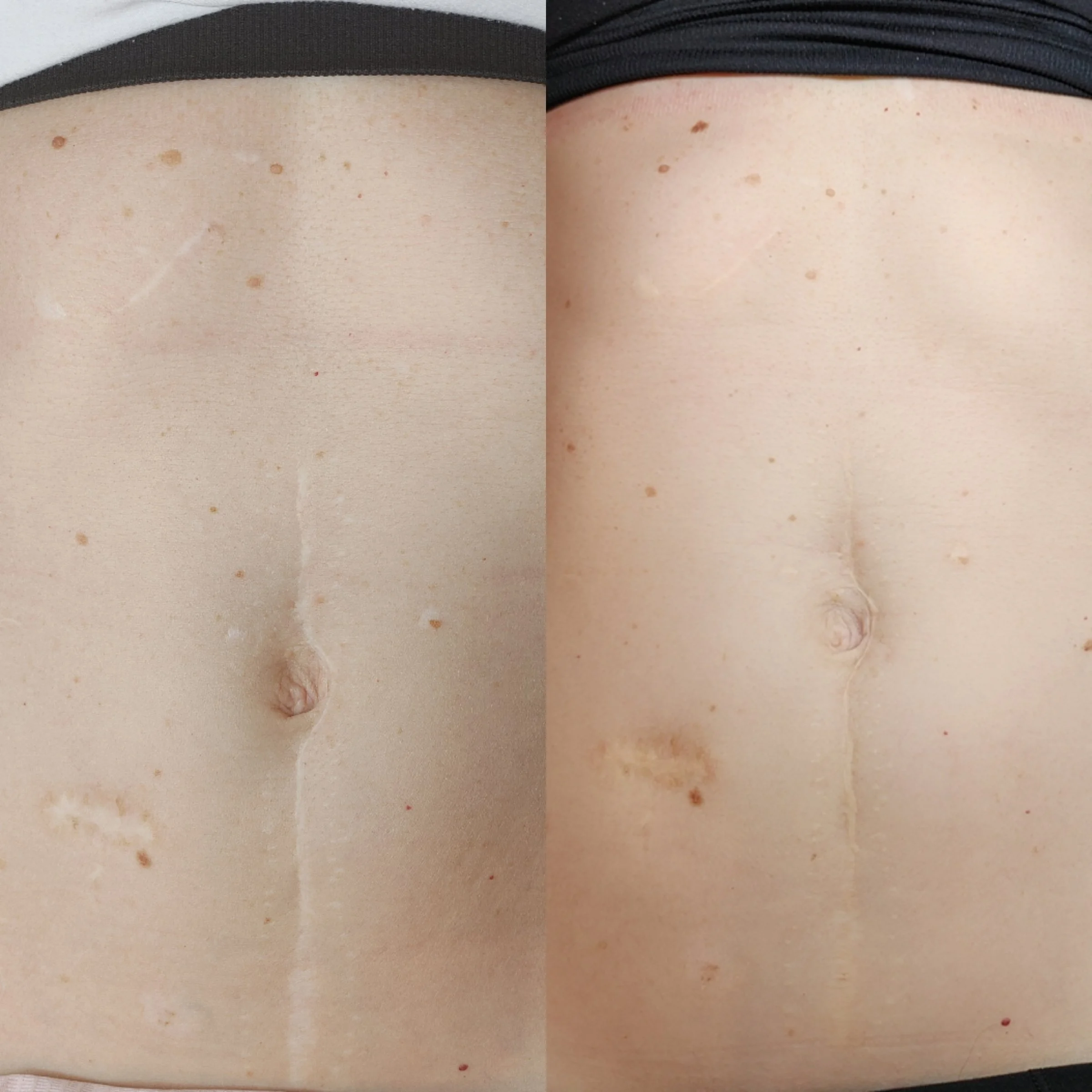 FAQ Stretchmark Camouflage