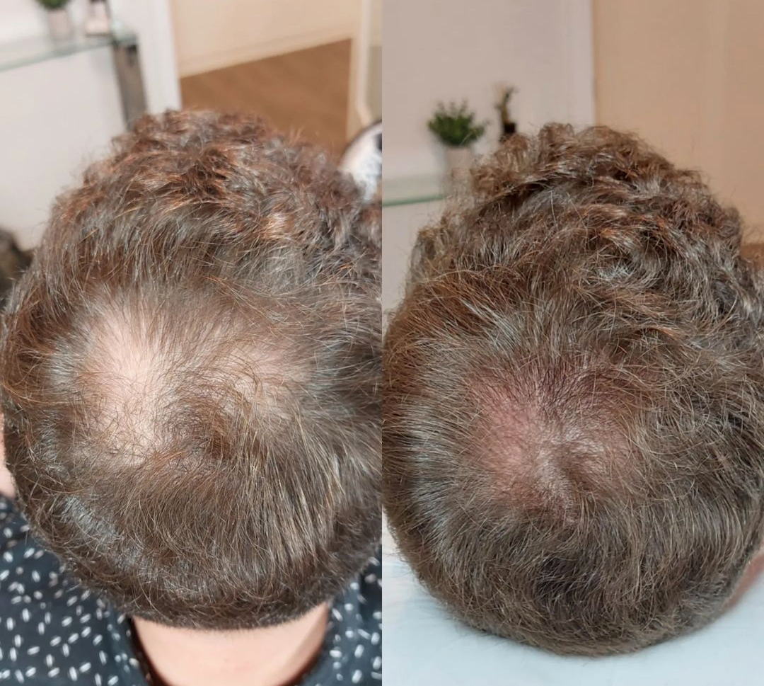FAQ about Scalp Micropigmentation