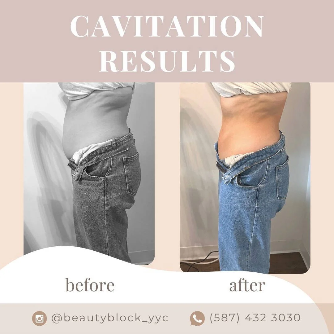 FAQ Ultrasonic Cavitation