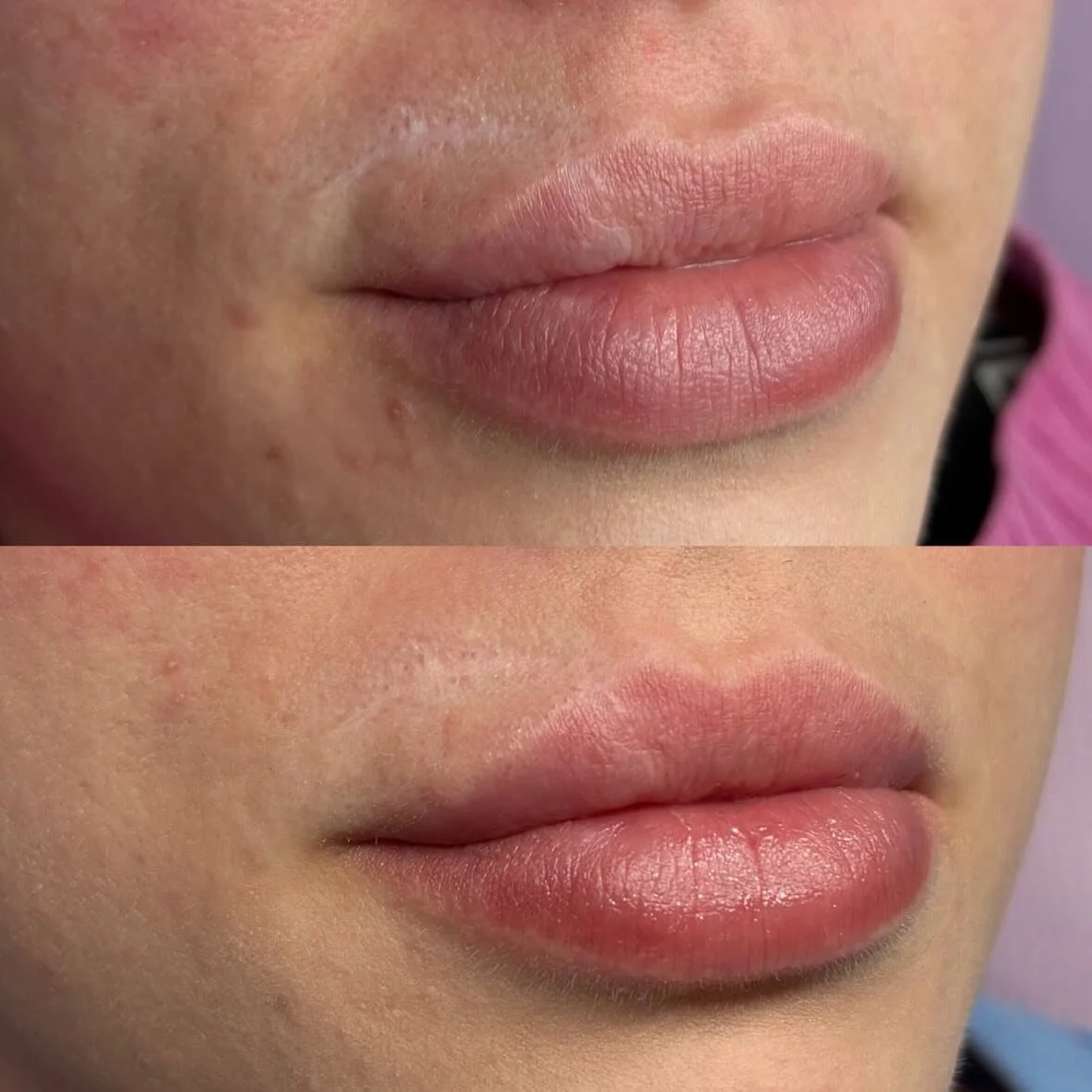 Subtle, but powerful ✨

Scar camouflage on the lip is all about precision and patience. For this client, we used a custom flesh-tone pigment to soften the appearance of her scar, along with a very targeted touch of lip blushing to help everything ble
