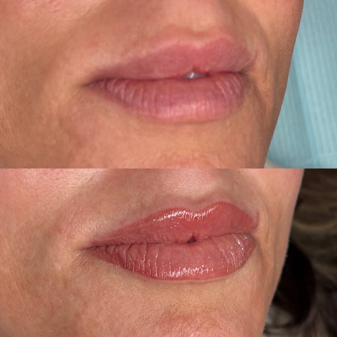 📸 Blurry before, crisp after. Just how we like it. 😉😆

But the after? 😍

This beautiful lip blush treatment was done to restore and define her natural lip border, creating a softer, more youthful shape while enhancing her natural colour.

💋 One 