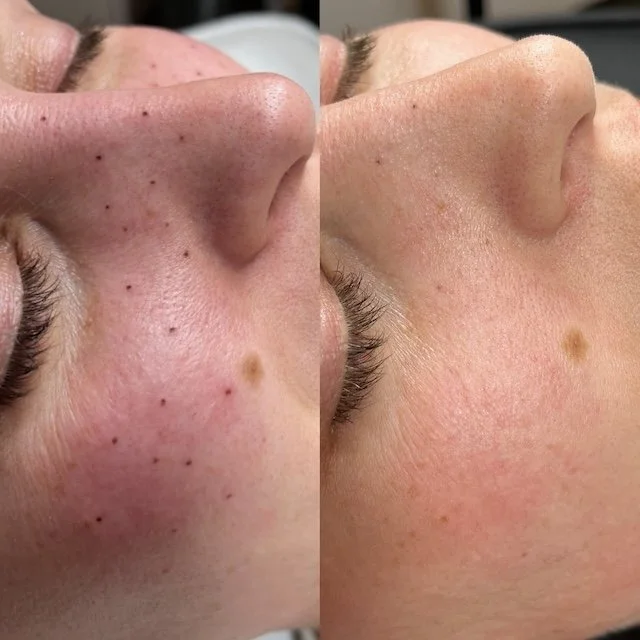 Before and after of freckle removal with saline tattoo removal.