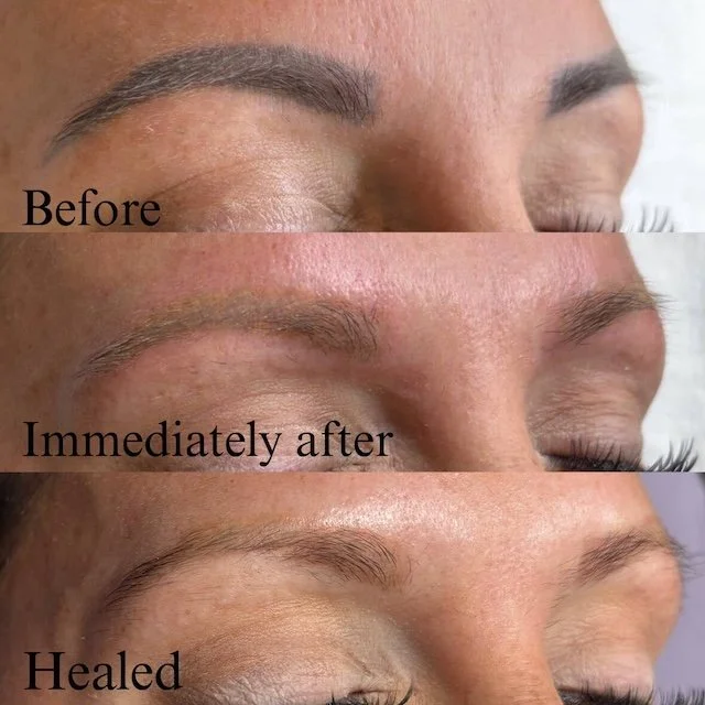 Laser brow removal process, before, immediately after with signigicantly faded tattoo, and then the healed result. The tattoo is very light and unnoticeable.