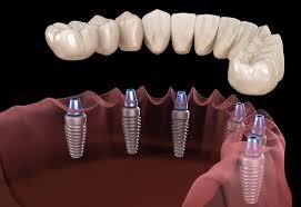 dental implant solutions for multiple teeth