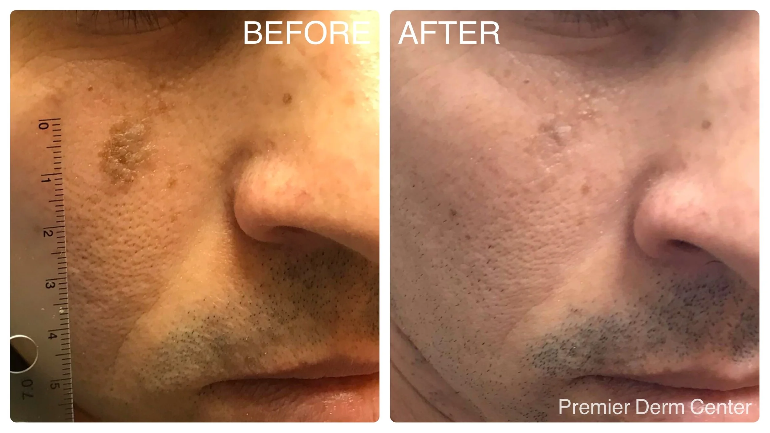 Brown Spots Treated by PicoWay Laser Premier Derm Center Cosmetic
