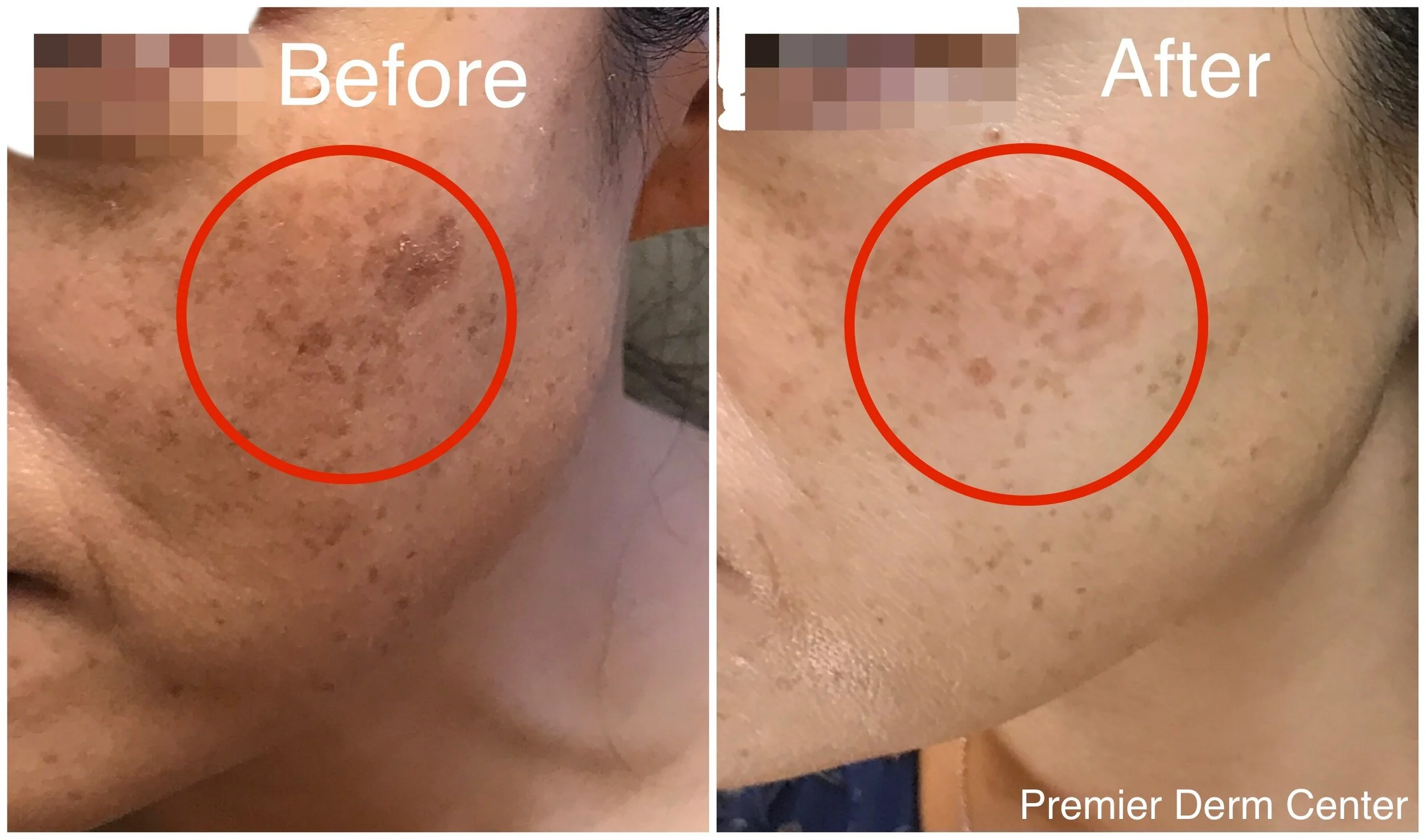 premier-derm-center-your-source-for-laser-brown-spot-removal