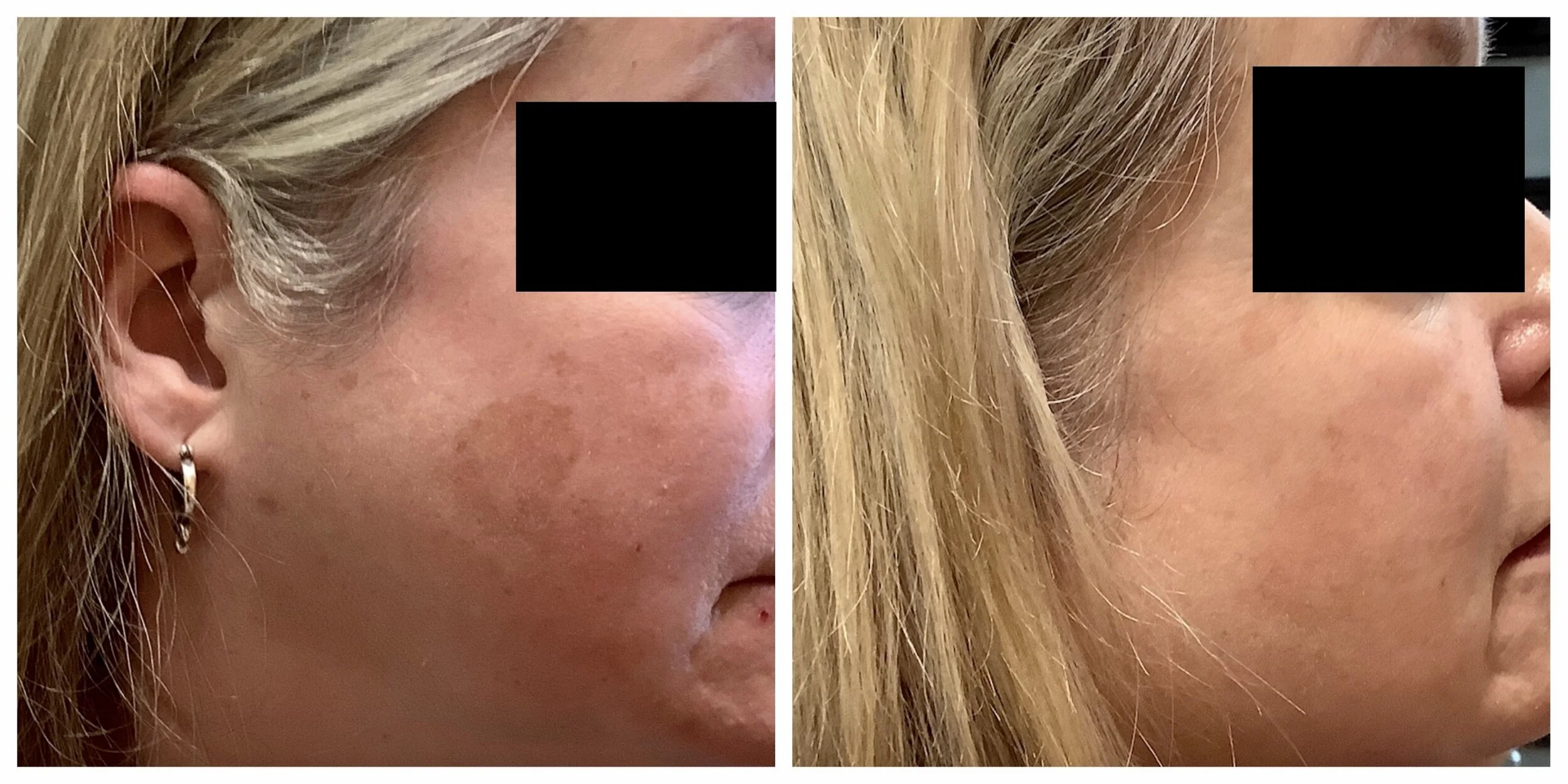 Premier Derm Center Your source for Laser Brown Spot Removal