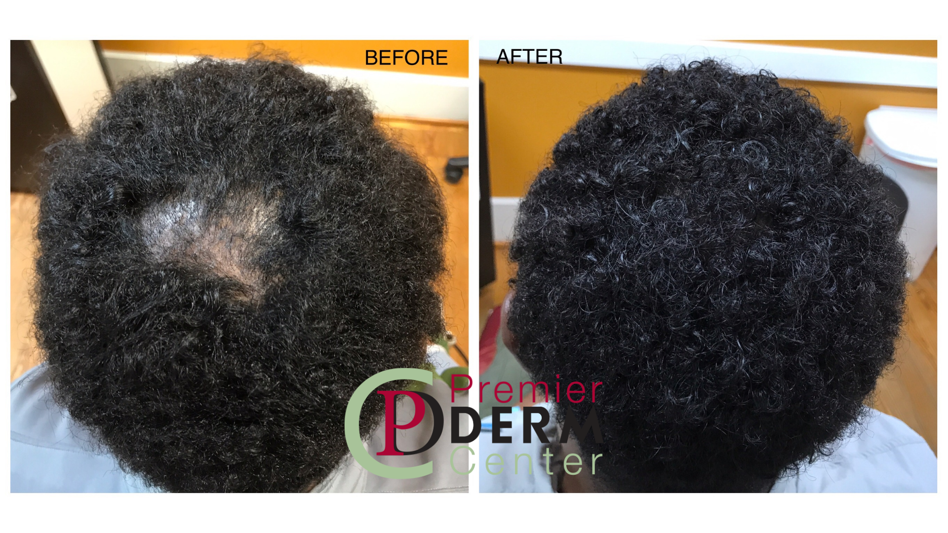 Platelet-Rich Plasma (PRP) Treatment for Hair Loss | Premier Derm Center -  Dermatologist in Houston Heights