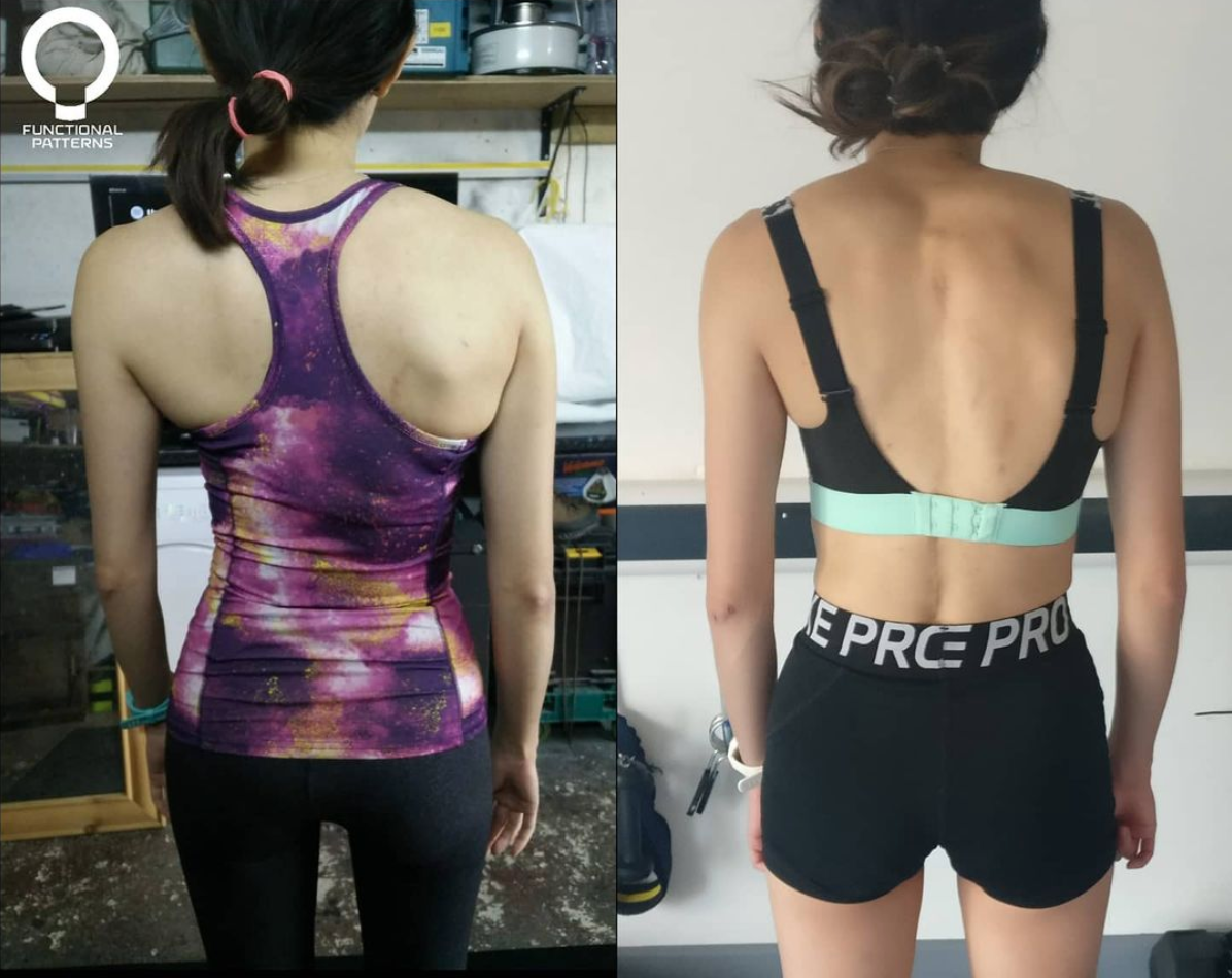 Scoliosis Specialist Brisbane