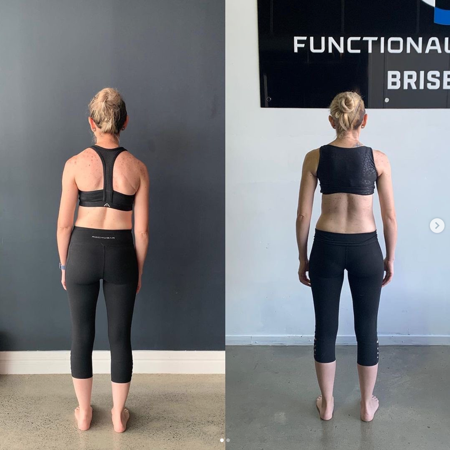 Incredible Scoliosis Results — Functional Patterns Brisbane