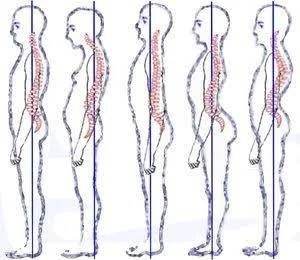 Anterior Pelvic Tilt: What It Is, Why It Happens, and How to Actually Fix It