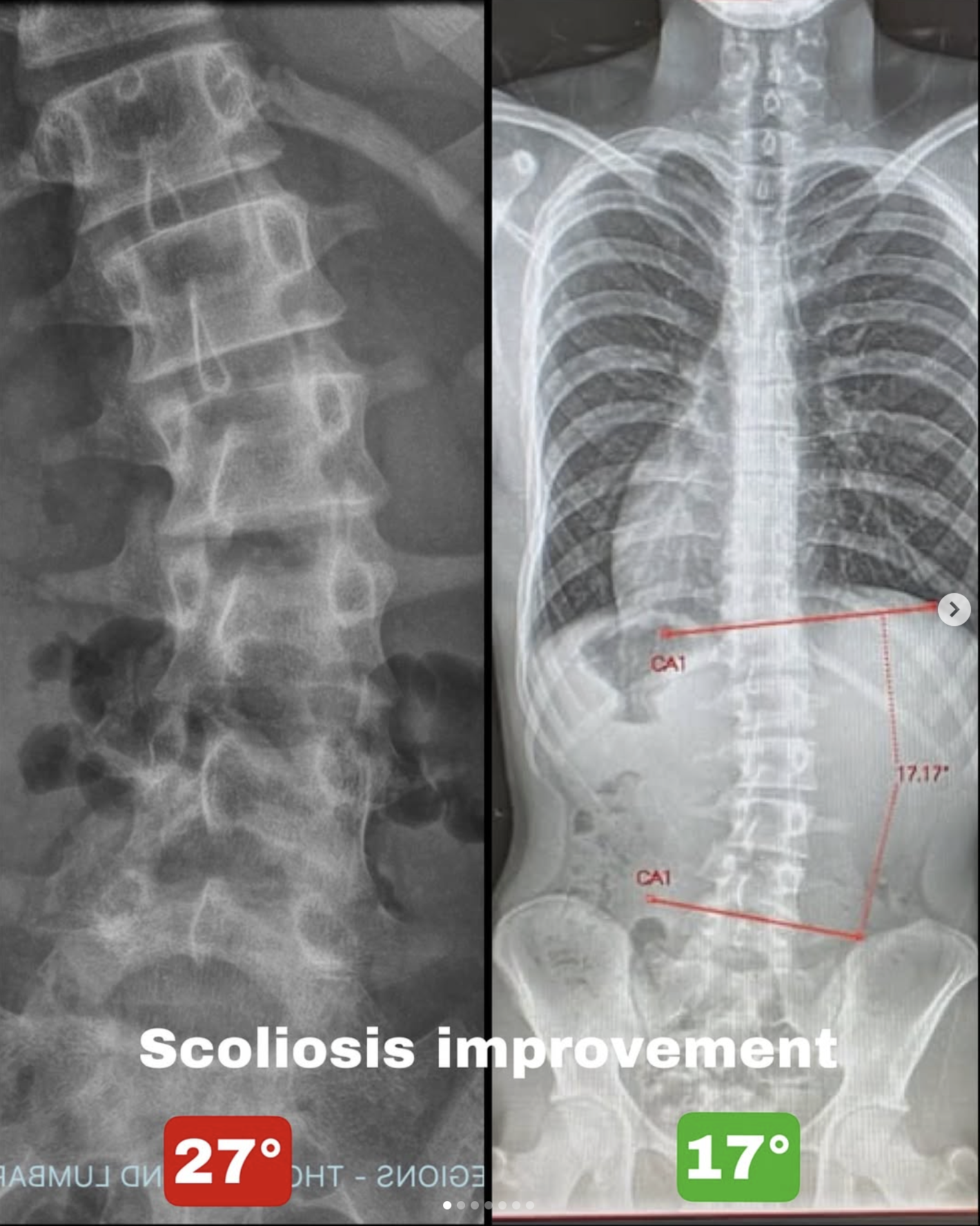 Functional Scoliosis, Lumbar Pain, and Return to Sport