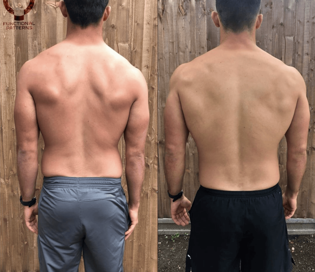 Clicking, Snapping, or Dislocated? Why Your Hip Stability Isn’t Found in a Brace