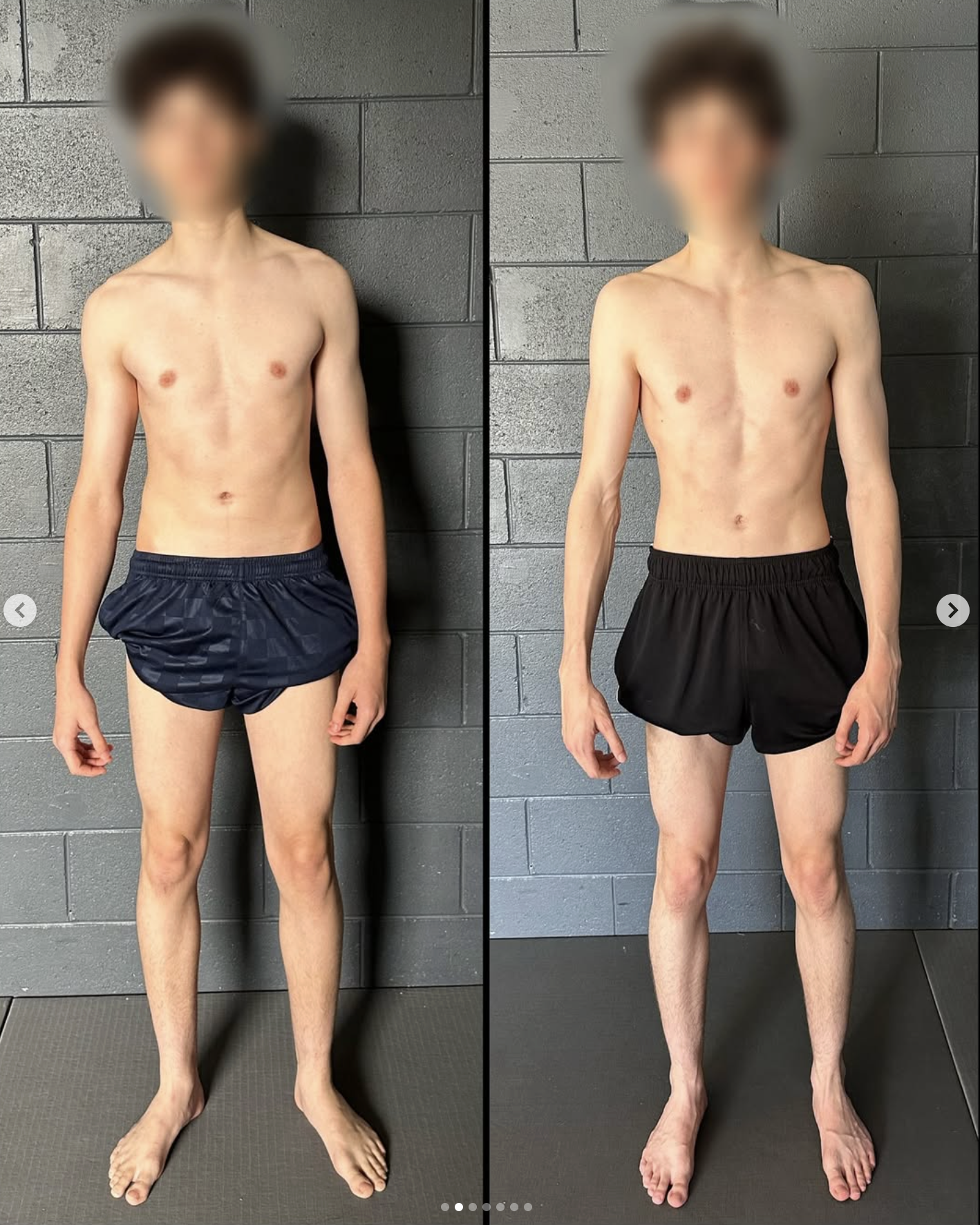 scoliosis surgery alternatives