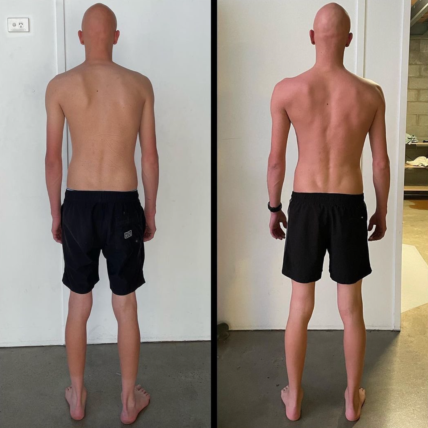Incredible Scoliosis Results — Functional Patterns Brisbane