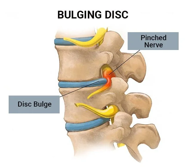 anatomy of bulging disc