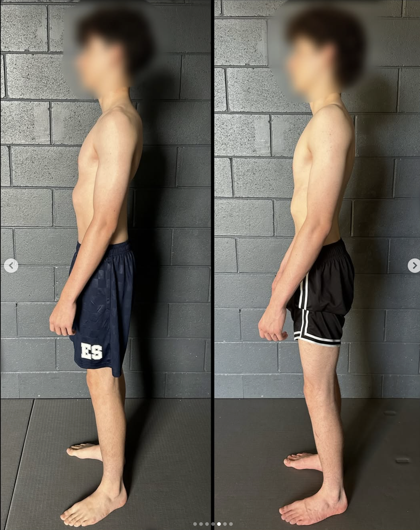 scoliosis surgery alternatives