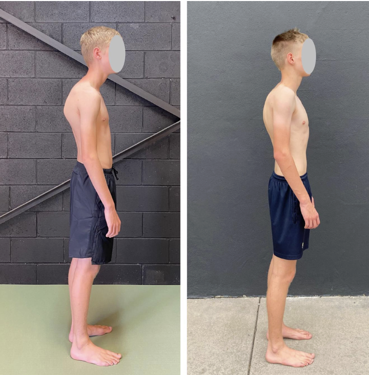 hunchback posture treatment exercises