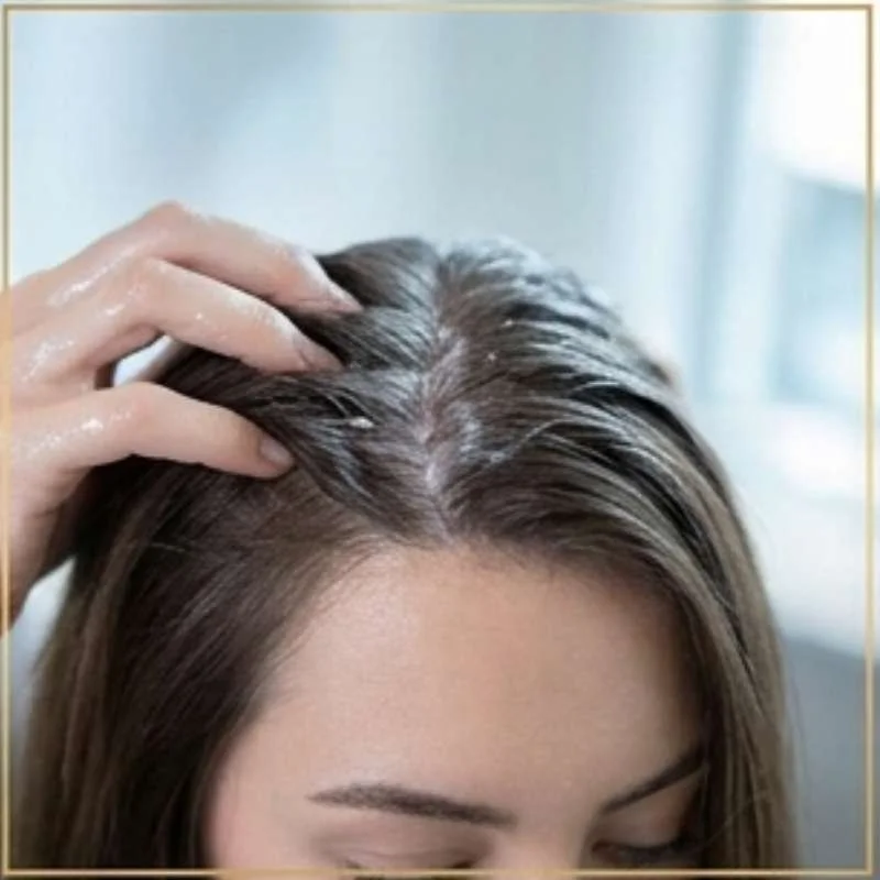 Dandruff Relief Scalp Treatment