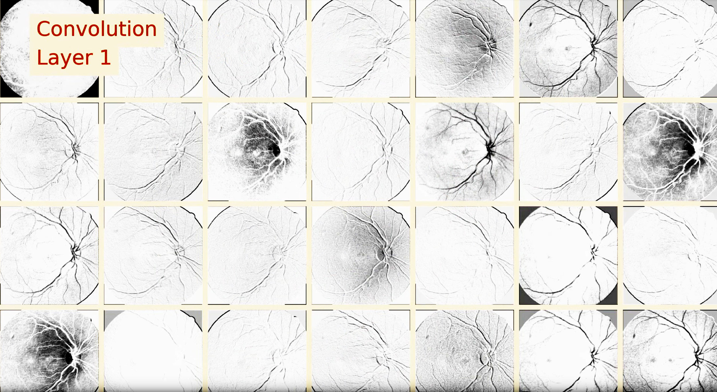 kaggle-dr-convolution.jpg