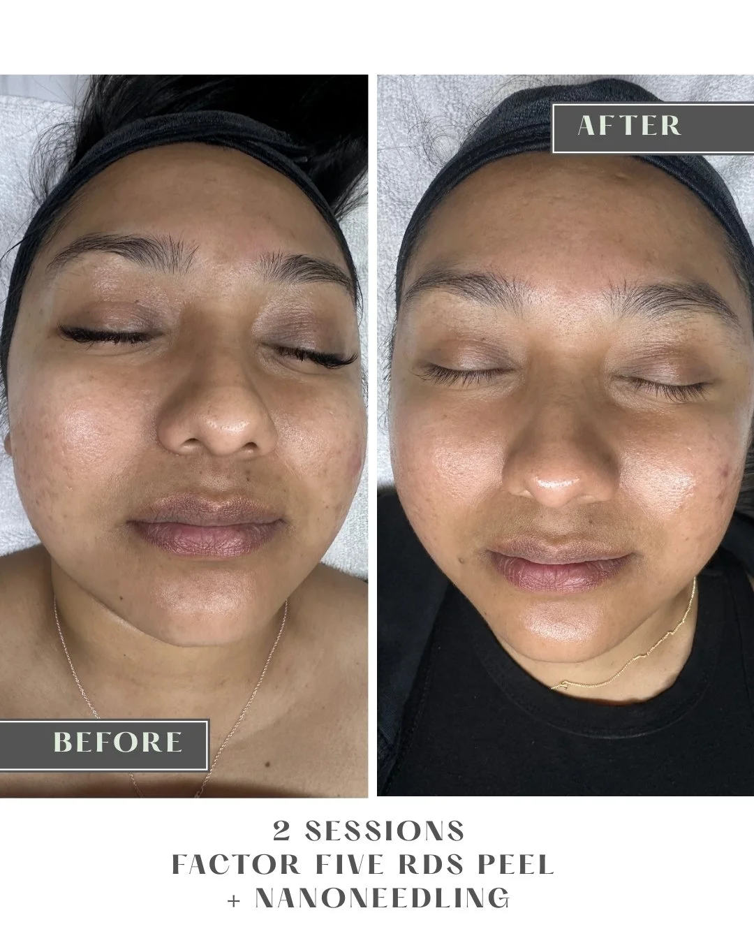 The Hidden Reason Your Skincare Isn’t Working: Why Barrier Health is the Foundation of Longevity