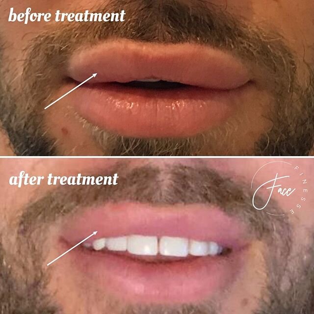 Lip correction by @facefinesse_london 
You can now book your lip corrective treatments with #FaceFinesse 
Unhappy with your temporary #fillers? Injection with hyalase can dissolve undesired results. After dissolution a new filler can be placed to rea