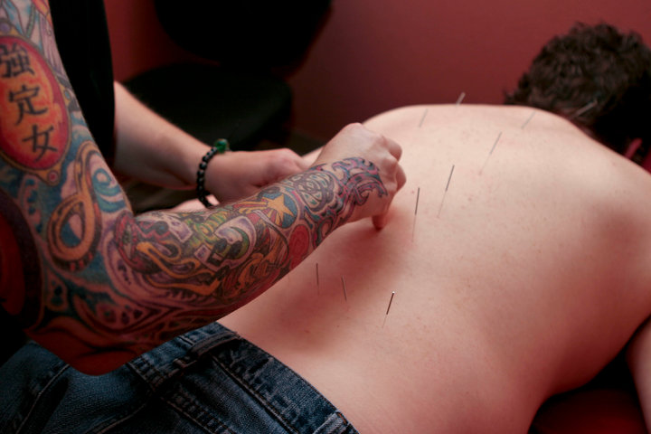 Acupuncture.jpg