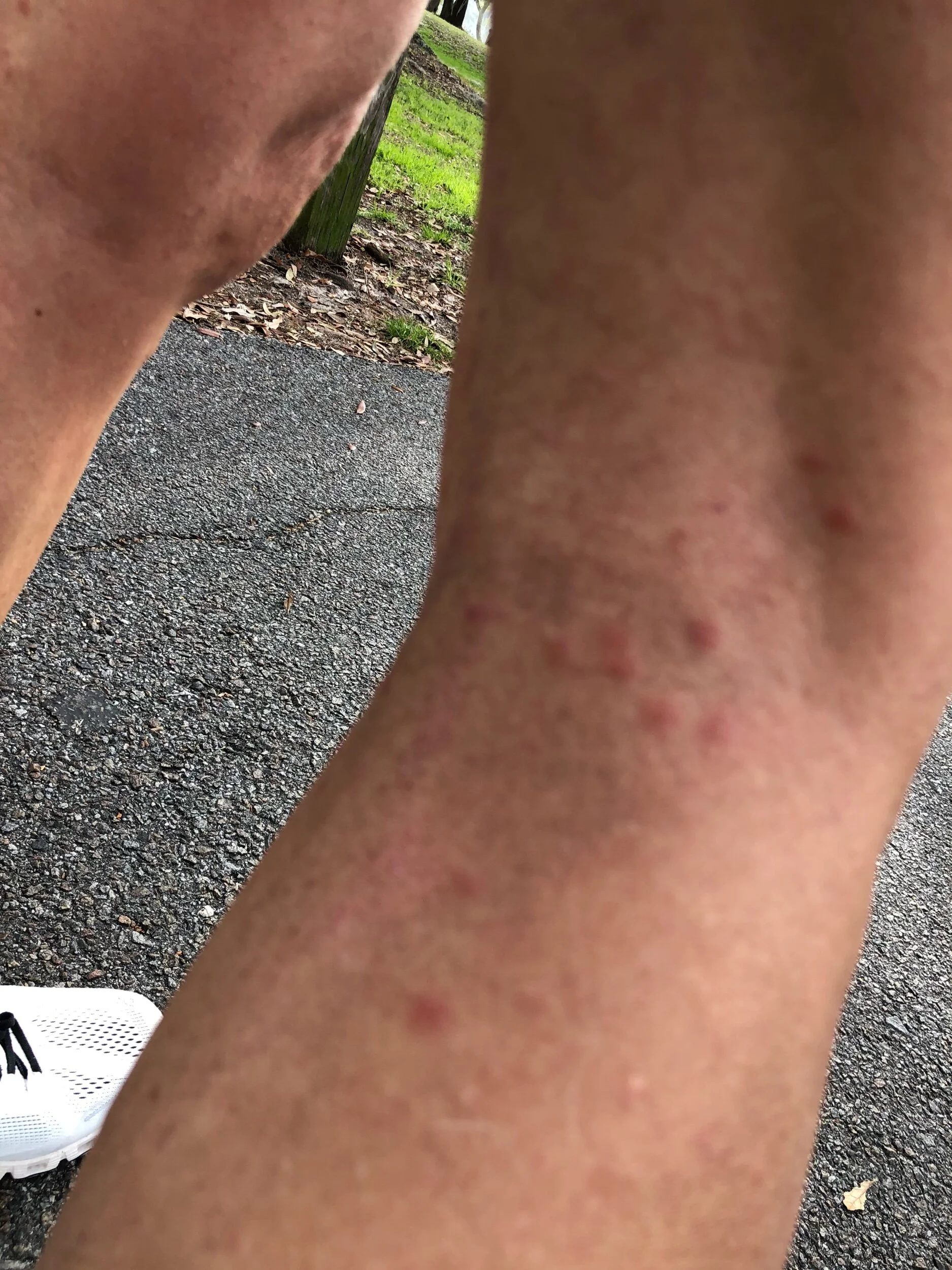 The gnat bites on the back of my damn knee.